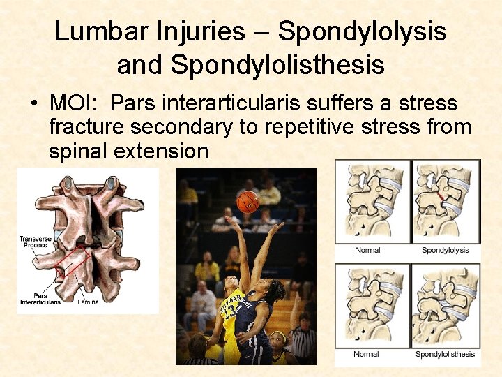 Lumbar Injuries – Spondylolysis and Spondylolisthesis • MOI: Pars interarticularis suffers a stress fracture Lumbar Injuries – Spondylolysis and Spondylolisthesis • MOI: Pars interarticularis suffers a stress fracture