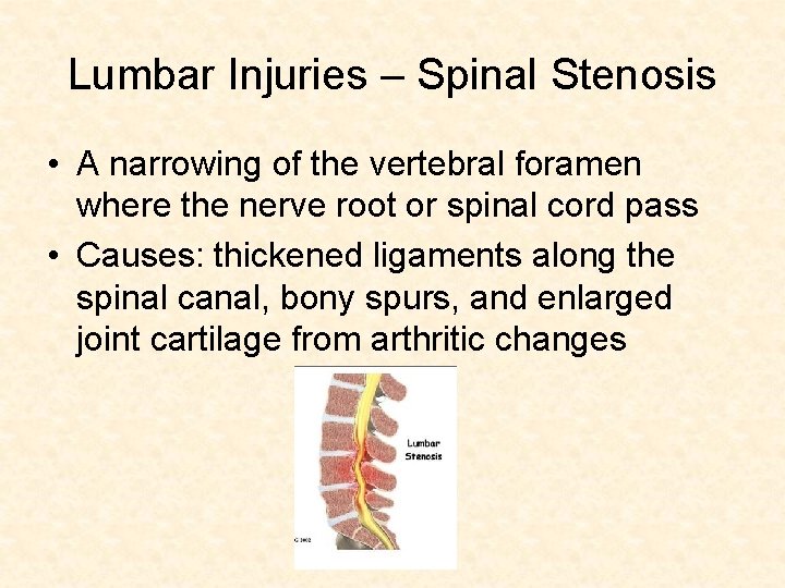 Lumbar Injuries – Spinal Stenosis • A narrowing of the vertebral foramen where the