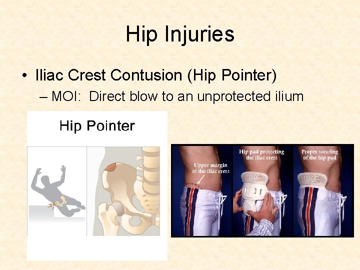 Hip Injuries • Iliac Crest Contusion (Hip Pointer) – MOI: Direct blow to an Hip Injuries • Iliac Crest Contusion (Hip Pointer) – MOI: Direct blow to an