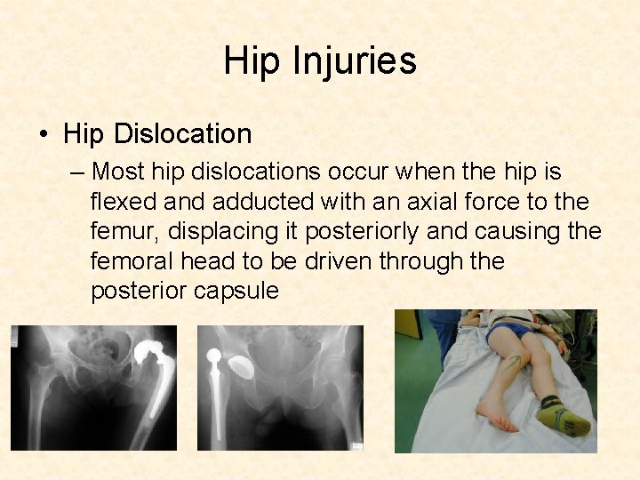 Hip Injuries • Hip Dislocation – Most hip dislocations occur when the hip is