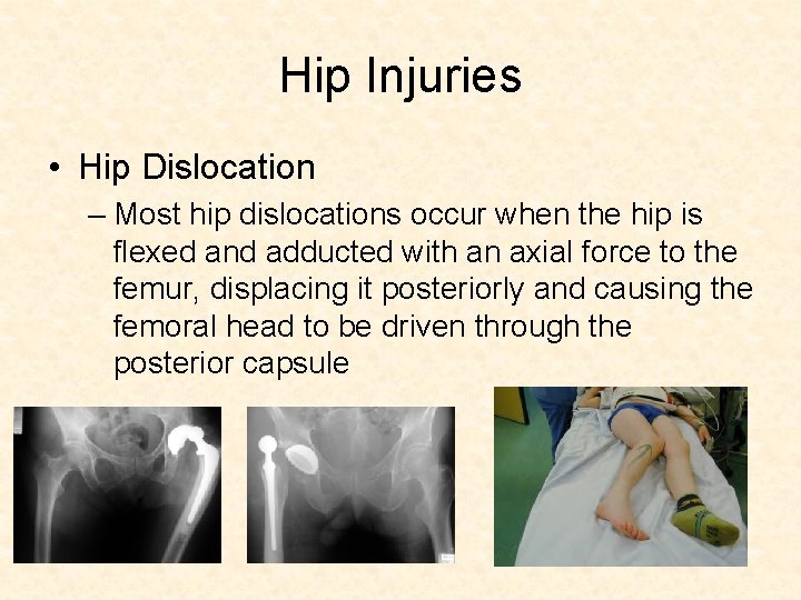Hip Injuries • Hip Dislocation – Most hip dislocations occur when the hip is Hip Injuries • Hip Dislocation – Most hip dislocations occur when the hip is