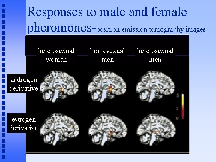 Responses to male and female pheromones-positron emission tomography images heterosexual women androgen derivative estrogen