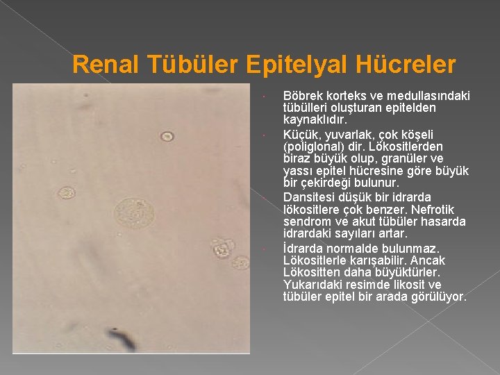 Renal Tübüler Epitelyal Hücreler Böbrek korteks ve medullasındaki tübülleri oluşturan epitelden kaynaklıdır. Küçük, yuvarlak,
