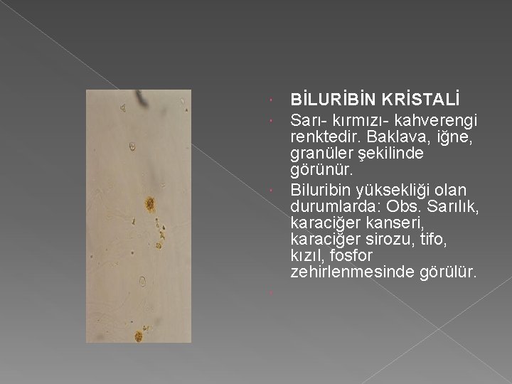  BİLURİBİN KRİSTALİ Sarı- kırmızı- kahverengi renktedir. Baklava, iğne, granüler şekilinde görünür. Biluribin yüksekliği