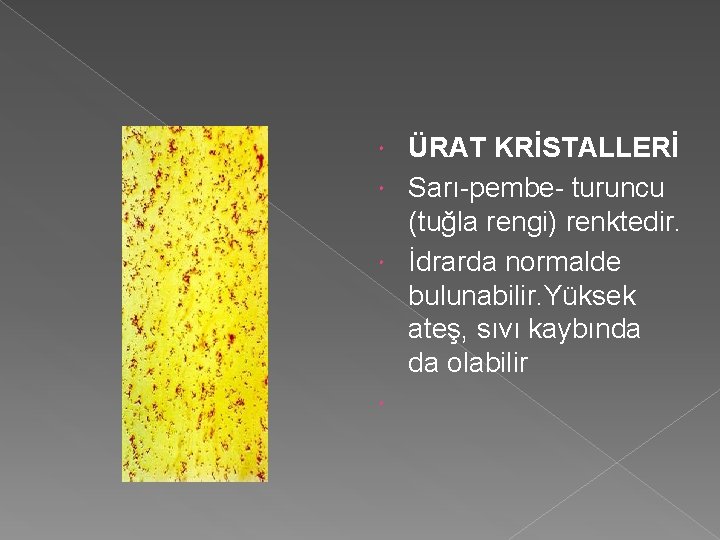 ÜRAT KRİSTALLERİ Sarı-pembe- turuncu (tuğla rengi) renktedir. İdrarda normalde bulunabilir. Yüksek ateş, sıvı kaybında