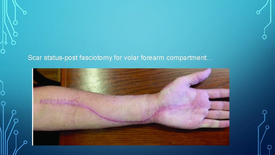 Scar status-post fasciotomy for volar forearm compartment… 