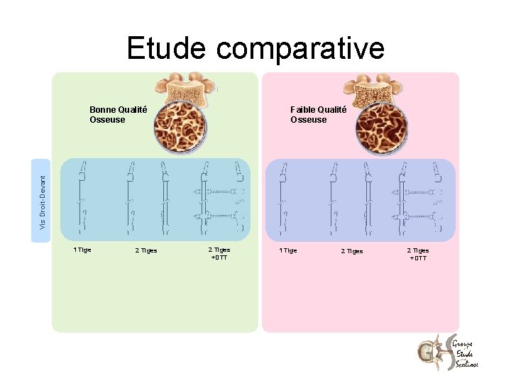 Etude comparative Faible Qualité Osseuse Vis Droit-Devant Bonne Qualité Osseuse 1 Tige 2 Tiges