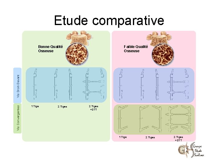 Etude comparative Faible Qualité Osseuse Vis Convergentes Vis Droit-Devant Bonne Qualité Osseuse 1 Tige