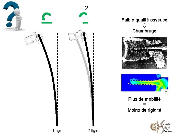 ÷ 2 Faible qualité osseuse Chambrage Plus de mobilité = Moins de rigidité 1