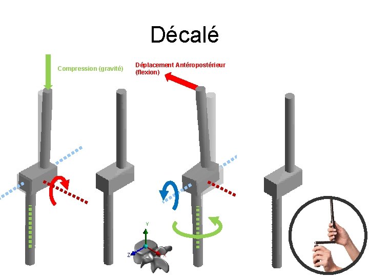 Décalé Compression (gravité) Déplacement Antéropostérieur (flexion) 