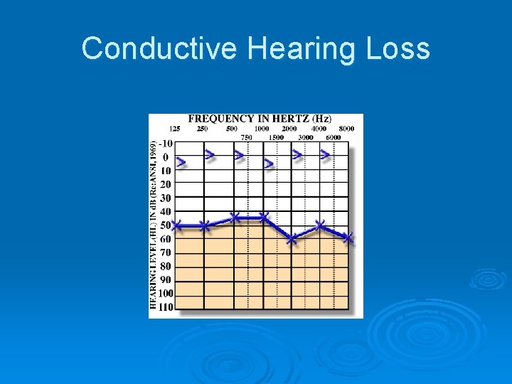 Conductive Hearing Loss 