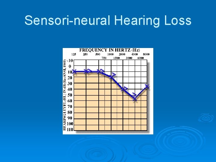 Sensori-neural Hearing Loss 