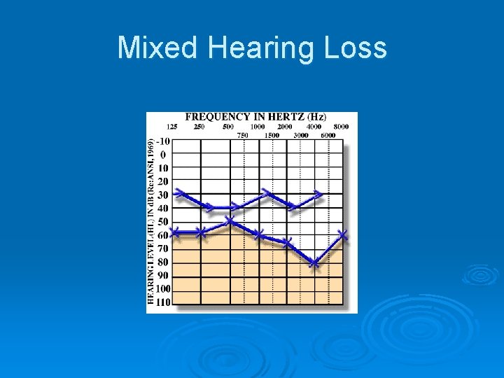 Mixed Hearing Loss 