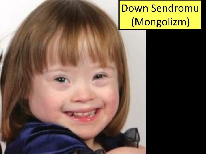 Down Sendromu (Mongolizm) 