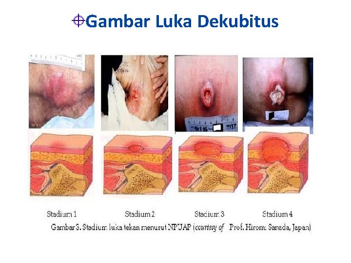 Gambar Luka Dekubitus 