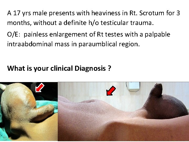 A 17 yrs male presents with heaviness in Rt. Scrotum for 3 months, without