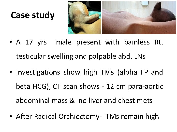 Case study • A 17 yrs male present with painless Rt. testicular swelling and