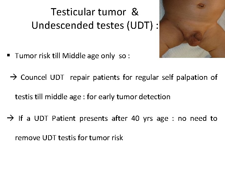 Testicular tumor & Undescended testes (UDT) : § Tumor risk till Middle age only