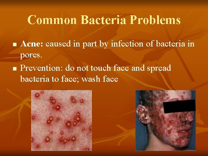 Common Bacteria Problems n n Acne: caused in part by infection of bacteria in