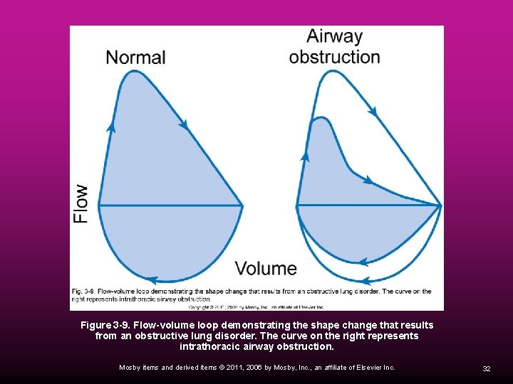 Figure 3 -9. Flow-volume loop demonstrating the shape change that results from an obstructive
