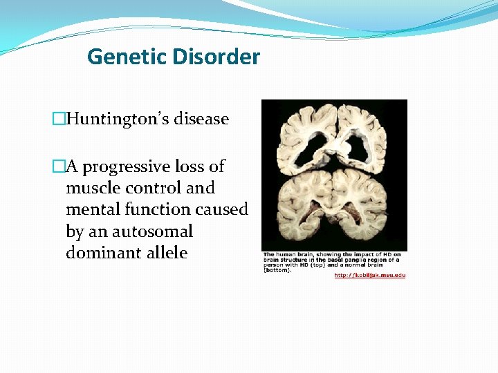 Genetic Disorder �Huntington’s disease �A progressive loss of muscle control and mental function caused Genetic Disorder �Huntington’s disease �A progressive loss of muscle control and mental function caused