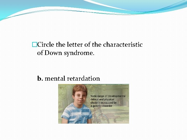 �Circle the letter of the characteristic of Down syndrome. b. mental retardation �Circle the letter of the characteristic of Down syndrome. b. mental retardation