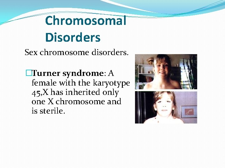 Chromosomal Disorders Sex chromosome disorders. �Turner syndrome: A female with the karyotype 45, X Chromosomal Disorders Sex chromosome disorders. �Turner syndrome: A female with the karyotype 45, X