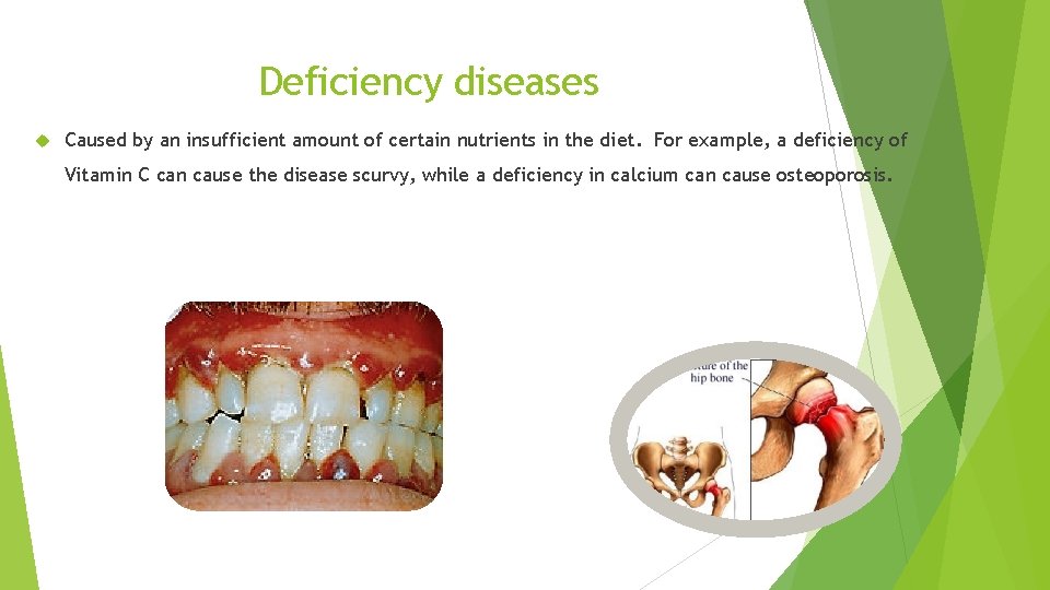 Deficiency diseases Caused by an insufficient amount of certain nutrients in the diet. For