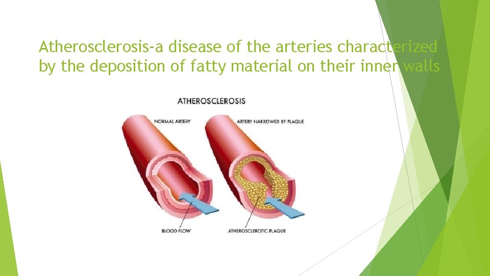 Atherosclerosis-a disease of the arteries characterized by the deposition of fatty material on their