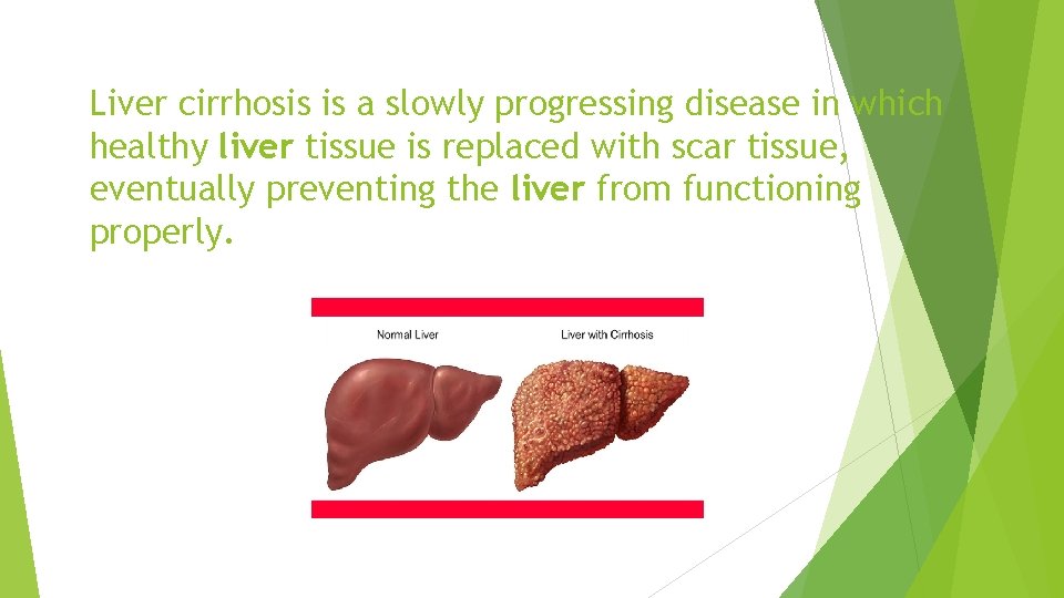 Liver cirrhosis is a slowly progressing disease in which healthy liver tissue is replaced
