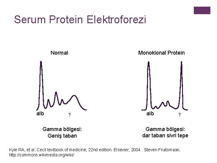 Serum Protein Elektroforezi Normal a. Ib Monoklonal Protein Gamma bölgesi: Geniş taban a. Ib