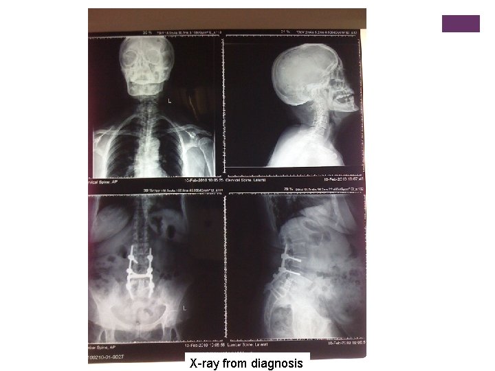 X-ray from diagnosis 