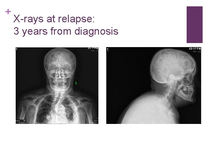 + X-rays at relapse: 3 years from diagnosis 
