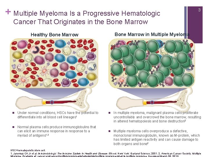 + Multiple Myeloma Is a Progressive Hematologic 3 Cancer That Originates in the Bone