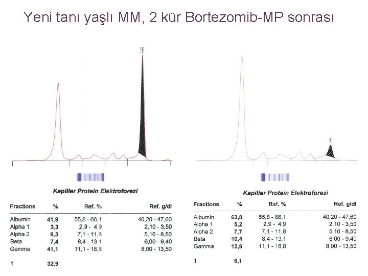 Yeni tanı yaşlı MM, 2 kür Bortezomib-MP sonrası 