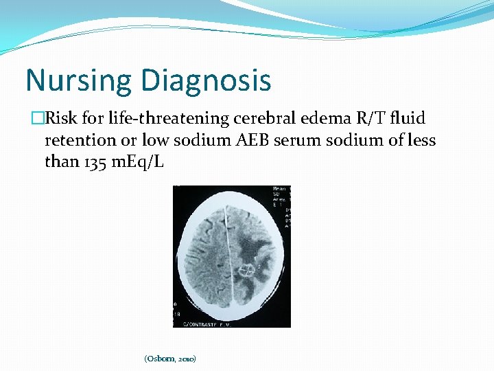 Nursing Diagnosis �Risk for life-threatening cerebral edema R/T fluid retention or low sodium AEB