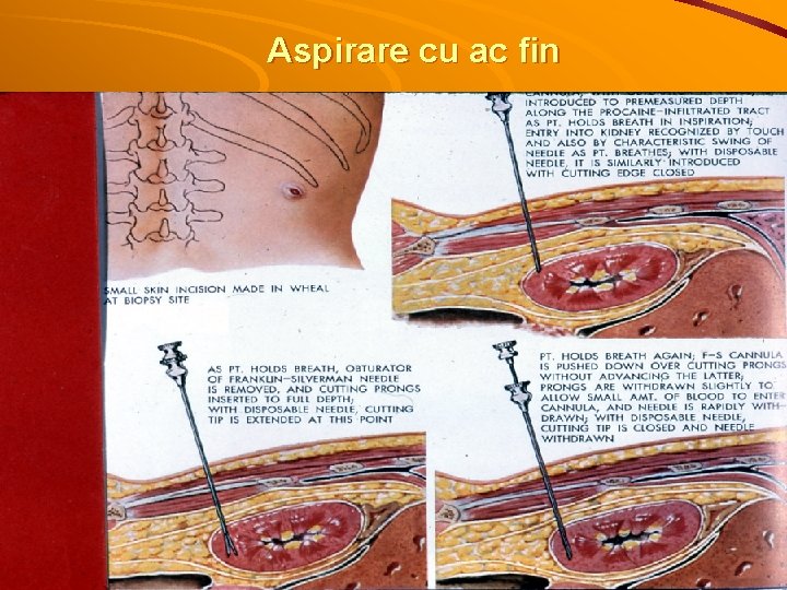 Aspirare cu ac fin 