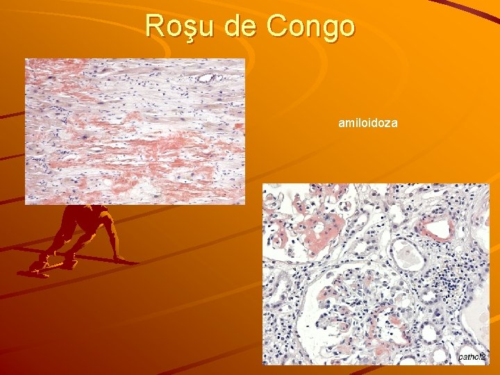 Roşu de Congo amiloidoza 