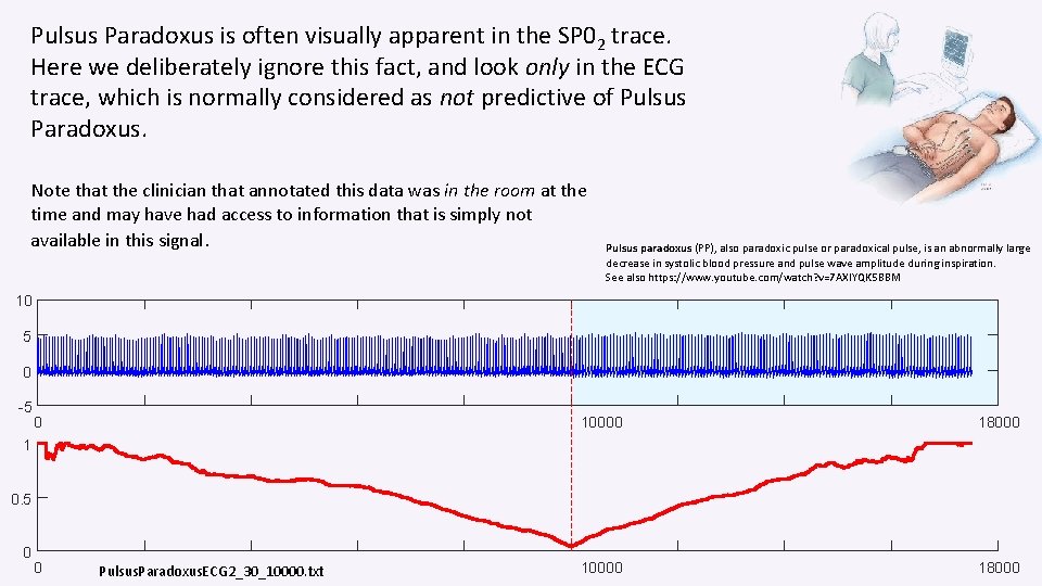 Pulsus Paradoxus is often visually apparent in the SP 02 trace. Here we deliberately