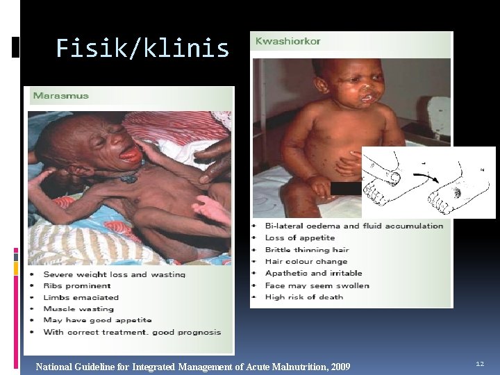 Fisik/klinis National Guideline for Integrated Management of Acute Malnutrition, 2009 12 