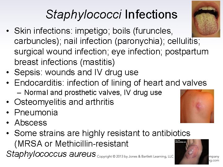Staphylococci Infections • Skin infections: impetigo; boils (furuncles, carbuncles); nail infection (paronychia); cellulitis; surgical