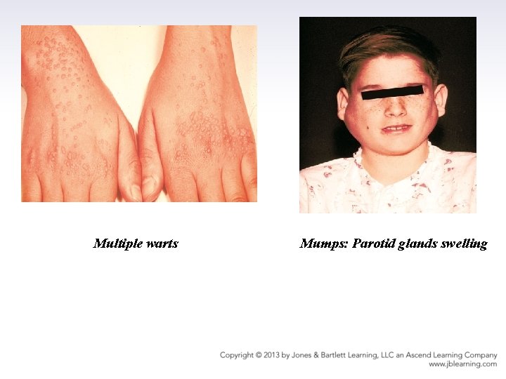 Multiple warts Mumps: Parotid glands swelling 