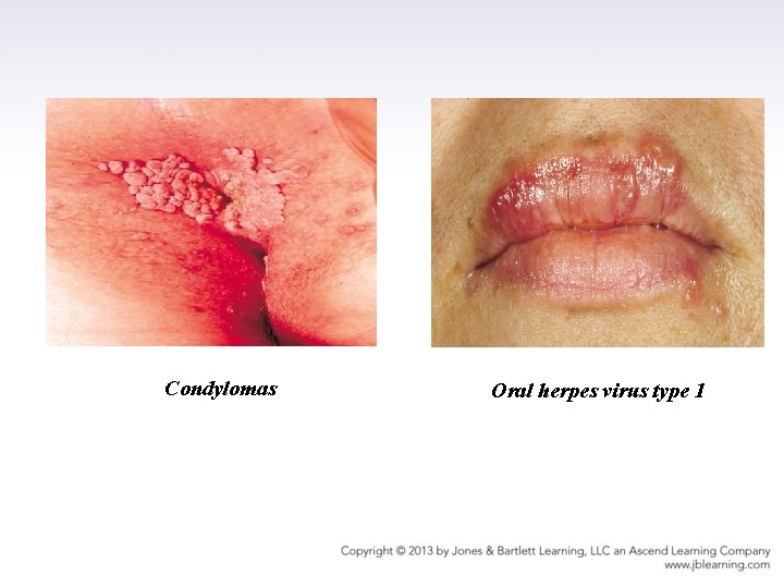 Condylomas Oral herpes virus type 1 