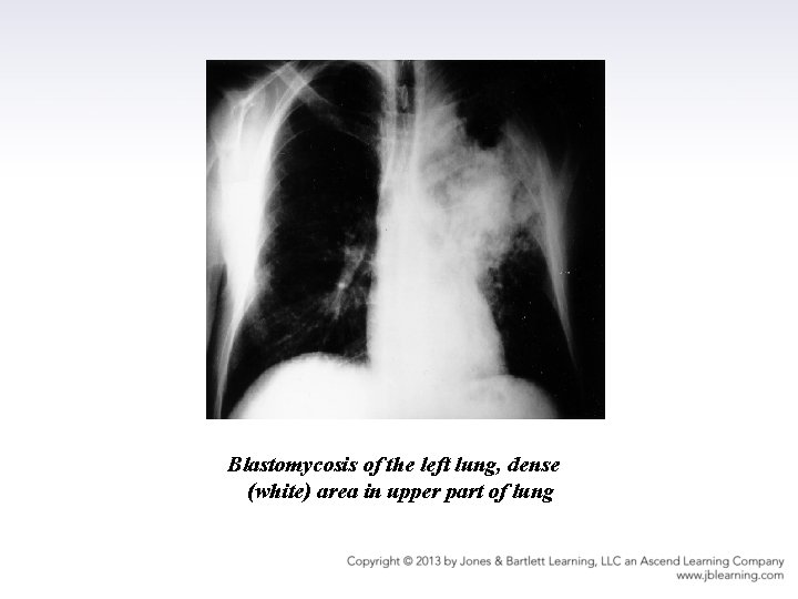 Blastomycosis of the left lung, dense (white) area in upper part of lung 