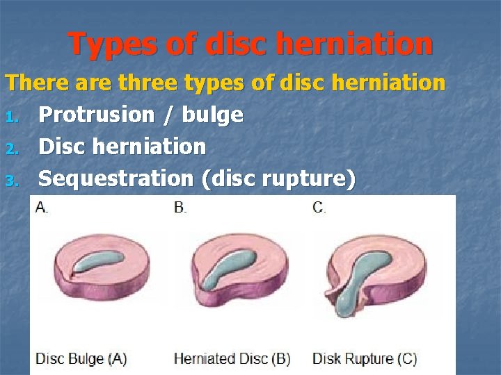 Types of disc herniation There are three types of disc herniation 1. Protrusion /