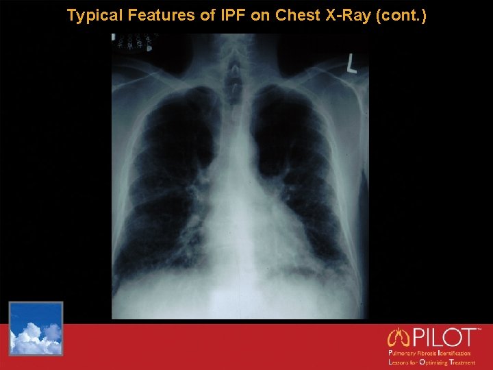 Typical Features of IPF on Chest X-Ray (cont. ) 
