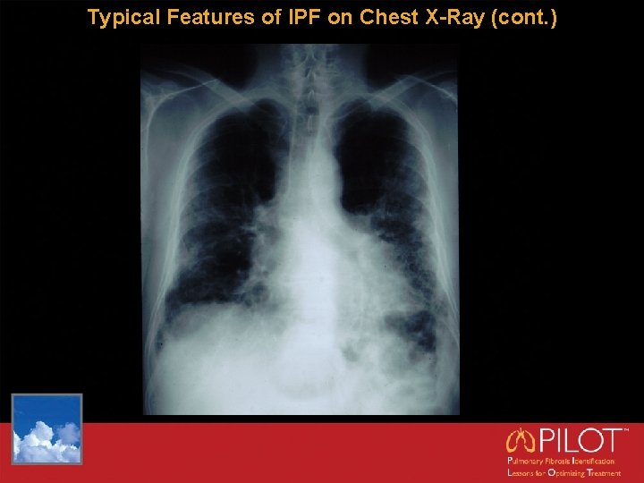 Typical Features of IPF on Chest X-Ray (cont. ) 