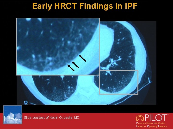 Early HRCT Findings in IPF Slide courtesy of Kevin O. Leslie, MD. 