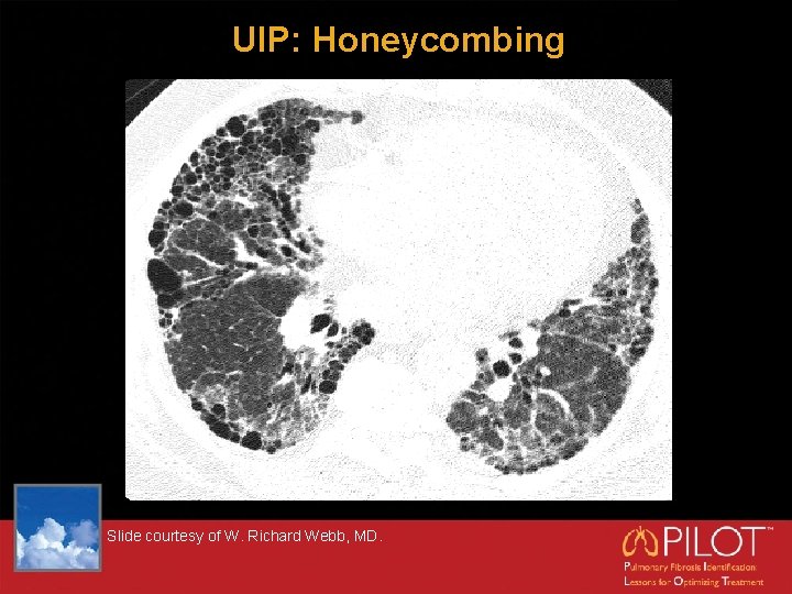 UIP: Honeycombing Slide courtesy of W. Richard Webb, MD. 