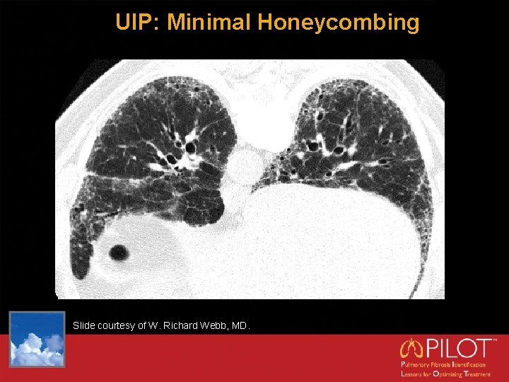 UIP: Minimal Honeycombing Slide courtesy of W. Richard Webb, MD. 